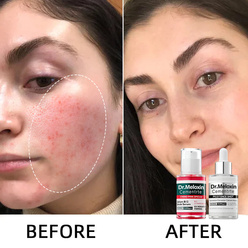 💥Shrinks Pores & Fades Blemish Marks in 2 Weeks | Cyano Pink Spicule Serum+Picotonic Shot Ampoule