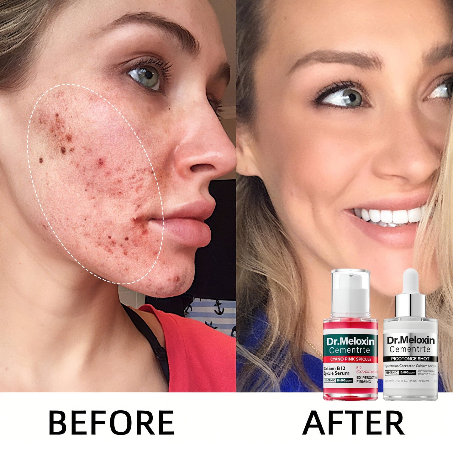 💥Shrinks Pores & Fades Blemish Marks in 2 Weeks | Cyano Pink Spicule Serum+Picotonic Shot Ampoule
