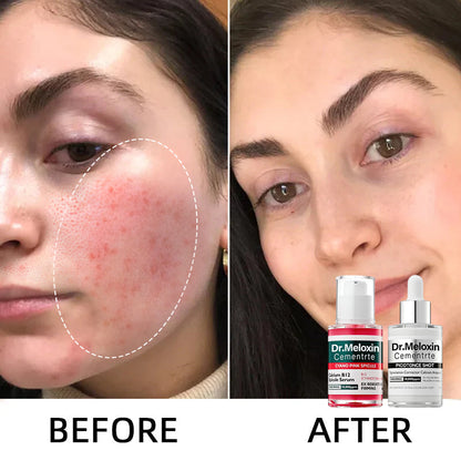 💥Shrinks Pores & Fades Blemish Marks in 2 Weeks | Cyano Pink Spicule Serum+Picotonic Shot Ampoule