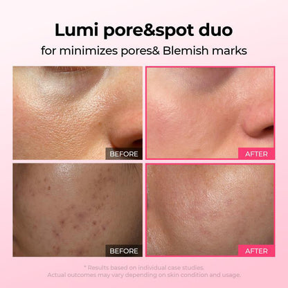 💥Shrinks Pores & Fades Blemish Marks in 2 Weeks | Cyano Pink Spicule Serum+Picotonic Shot Ampoule